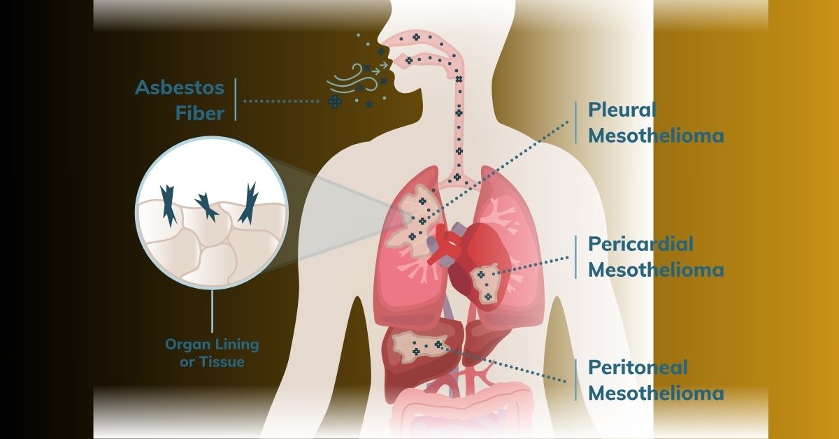 Mesothelioma and Asbestos